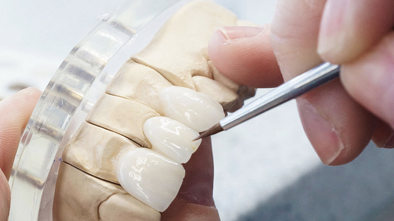 Lentes de Porcelana vs. Facetas Dentárias: Qual a melhor opção para o seu sorriso?